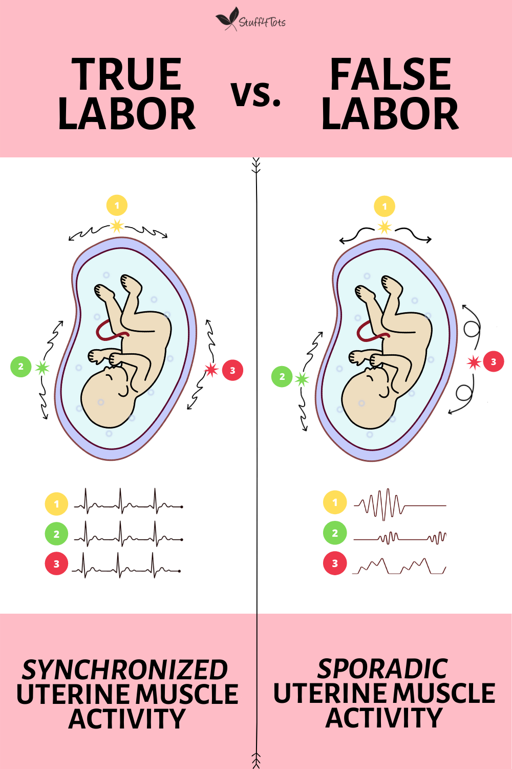 Pin On Pregnancy 3Rd Trimester throughout Labour Contractions Timing Chart