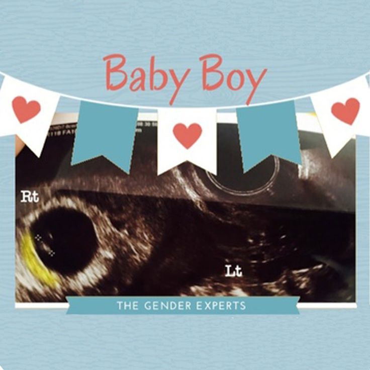 Confirmed Ultrasound Scans  A Collection Of Boy And Girl pertaining to Twin Gender Predictor