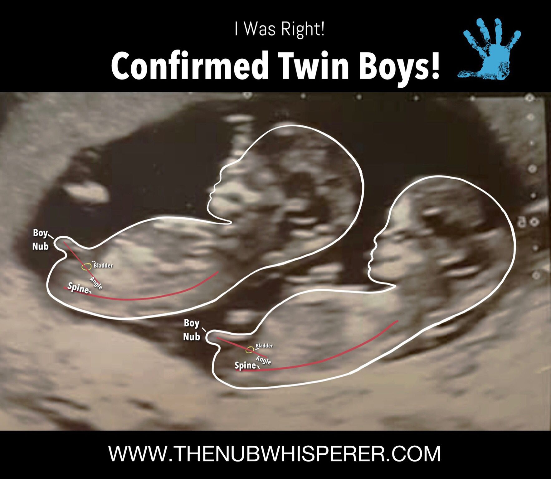 Gender Prediction On Twins! | Gender Prediction, Twin Boys in Twin Gender Predictor