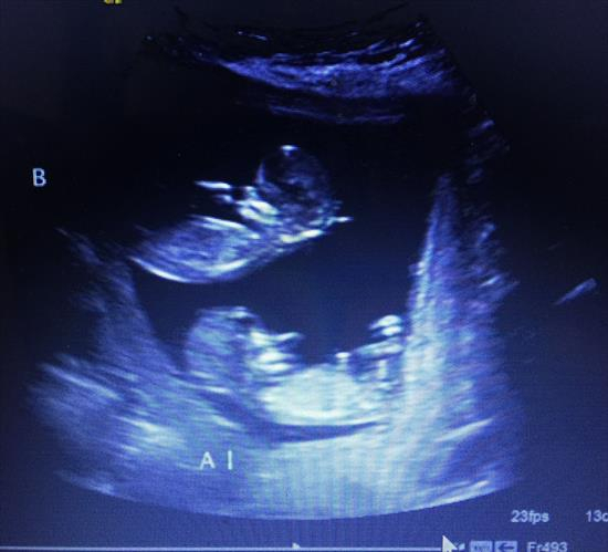 Twins! 12W1D Scanboys Or Girls? In Ultrasound Gender with regard to Twin Gender Predictor