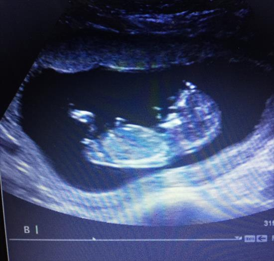 Twins! 12W1D Scanboys Or Girls? In Ultrasound Gender within Twin Gender Predictor